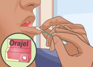 oral gel for ulcers with braces