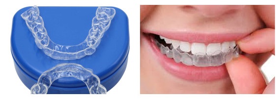 invisalign-vs-metal-braces-a-clear-comparison - Best Dental Clinic In  Bangalore Indiranagar