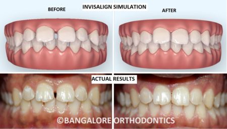 Before & After Invisalign