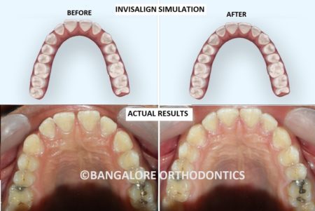 bangaloreinvisaligncasestudy-gaps