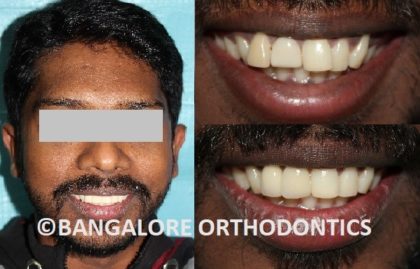 bangaloreorthodontics-inman-aligner-misaligned-teeth-correction.jpg