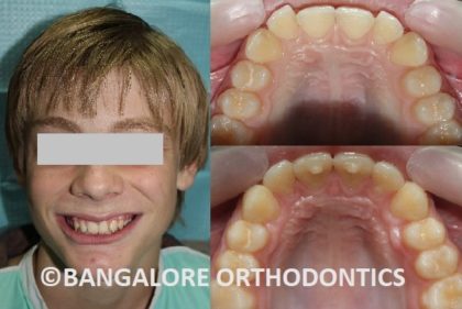 bangaloreorthodontics-inman-retrudedteethcase