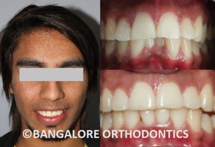 bangaloreorthodontics-invisiblealigners-crowdedteeth