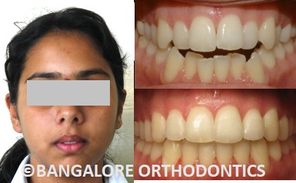 bangaloreorthodontics-invisiblealigners-crowding