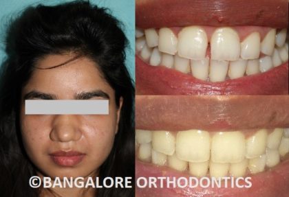 bangaloreorthodontics-invisiblealigners-gaps