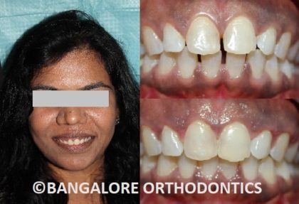 bangaloreorthodontics-invisiblealigners-gapsinteeth