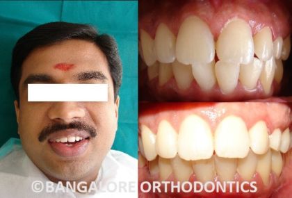 bangaloreorthodontics-invisiblealigners-misalignedteeth