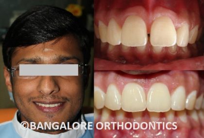 bangaloreorthodontics-invisiblealigners-protrudedteeth