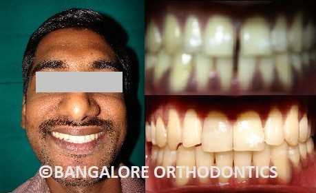 bangaloreorthodontics-invisiblealigners-teeth gaps