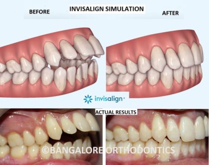 bangalore-invisalign-openbite case