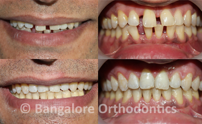 Teeth gaps closed with clear ceramic braces