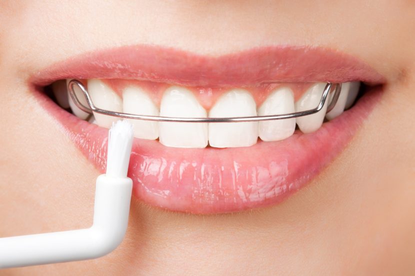 orthodontic retainer