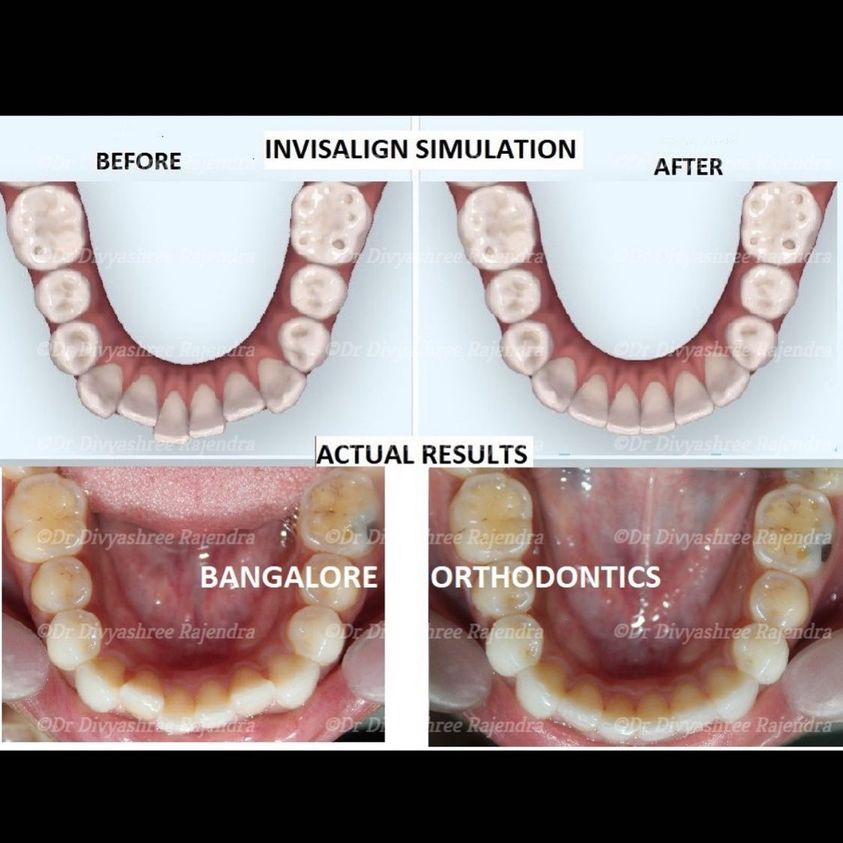 Before And After Invisalign Crowded Misaligned Teeth Correction In 3