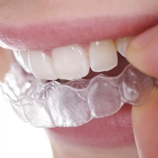 Aligners