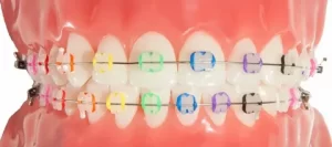 Coloured Ceramic Braces 