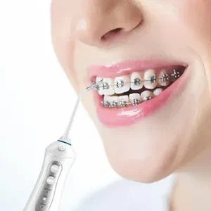 Standard Ceramic Braces 