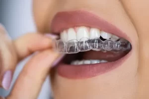 Teeth Aligners vs. Braces