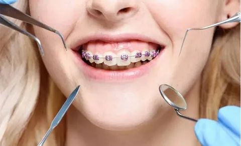 Metal Braces