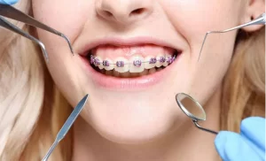 Clear Aligner