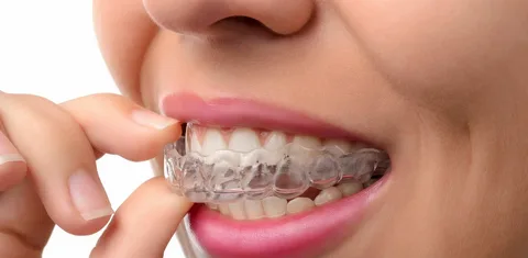 Transparent Retainer