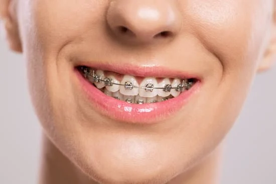 Braces Near