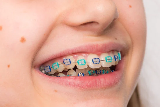 Braces for Adults