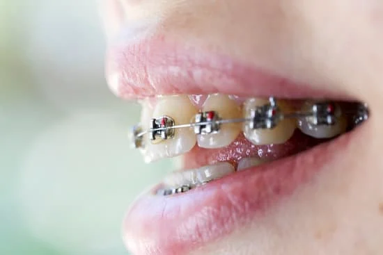 Braces for Adults