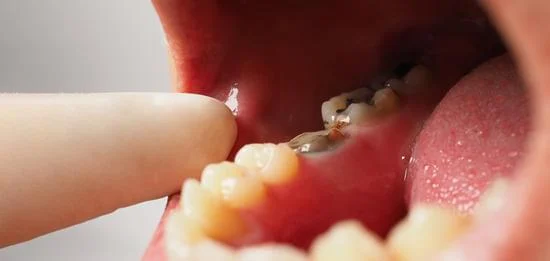 Permanent Teeth Gap Filling