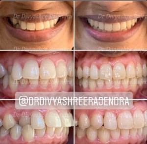 invisalign bangalore- crossbite before after       