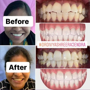 invisalign bangalore before after premolar extraction       
