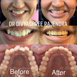 invisalign bangalore crowding before after       