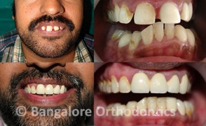 protruded-teeth-case1-damon-braces
