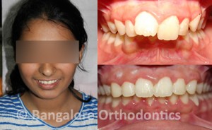 protruded-teeth-case1-metal-braces