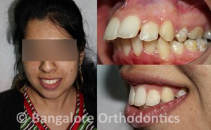 protruding-teeth-case (1)